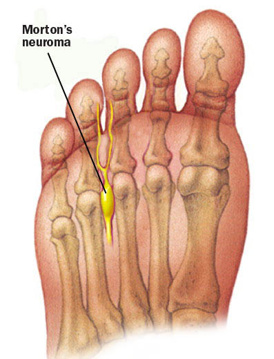 Morton's Neuroma